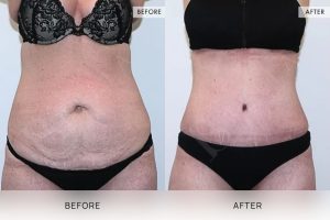 Tummy Tuck Patient 15 - 16