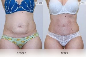 Tummy Tuck Patient 16 - 17
