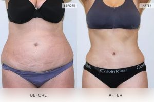 Tummy Tuck Patient 17 - 18
