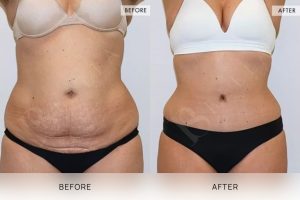 Tummy Tuck Patient 18 - 19