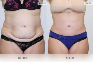 Tummy Tuck Patient 19 - 20