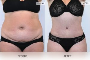 Tummy Tuck Patient 02 - 3