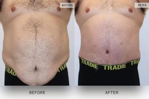Tummy Tuck Patient 20 - 21
