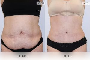 Tummy Tuck Patient 21 - 22