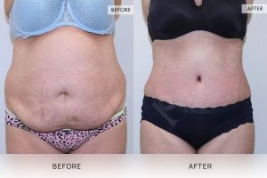 Tummy Tuck Patient 22 - 23