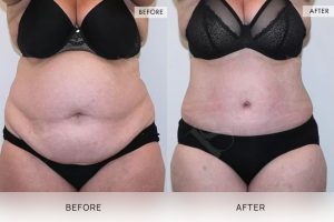 Tummy Tuck Patient 23 - 24