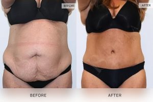 Tummy Tuck Patient 24 - 25