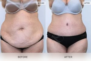 Tummy Tuck Patient 25 - 26