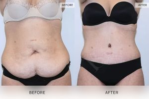 Tummy Tuck Patient 26 - 27