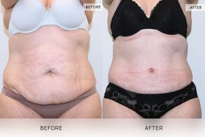 Tummy Tuck Patient 27 - 28