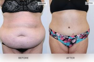 Tummy Tuck Patient 28 - 29