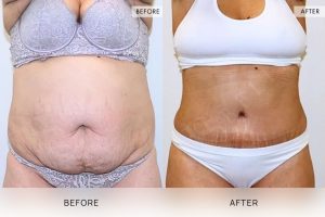 Tummy Tuck Patient 29 - 30