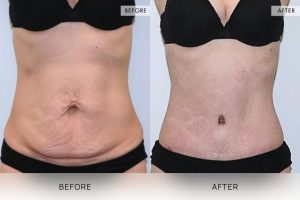 Tummy Tuck Patient 03 - 4