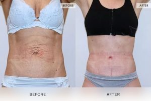 Tummy Tuck Patient 30 - 31