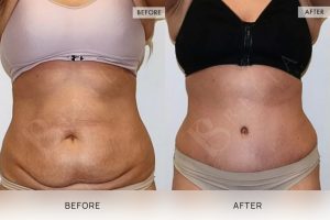Tummy Tuck Patient 31 - 32