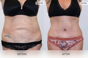 Tummy Tuck Patient 32 - 33