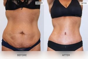 Tummy Tuck Patient 33 - 34