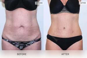 Tummy Tuck Patient 34 - 35