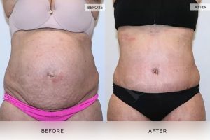 Tummy Tuck Patient 35 - 36