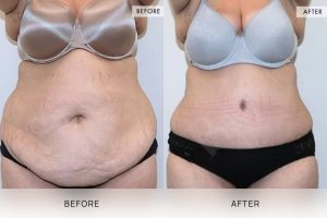 Tummy Tuck Patient 36 - 37