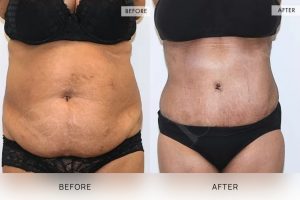 Tummy Tuck Patient 37 - 38