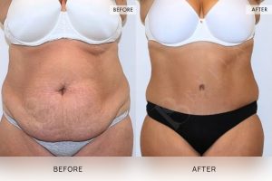 Tummy Tuck Patient 38 - 39
