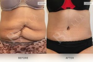 Tummy Tuck Patient 39 - 40
