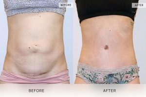 Tummy Tuck Patient 04 - 5