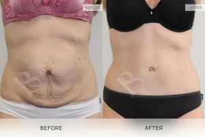 Tummy Tuck Patient 40 - 41