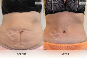 Tummy Tuck Patient 41 - 42