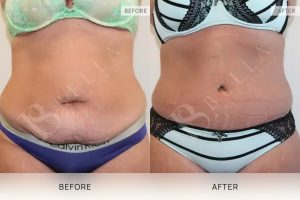 Tummy Tuck Patient 42 - 43