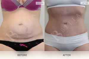 Tummy Tuck Patient 43 - 44
