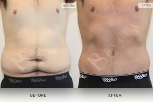 Tummy Tuck Patient 44 - 45