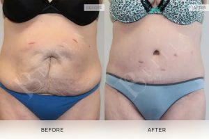 Tummy Tuck Patient 45 - 46