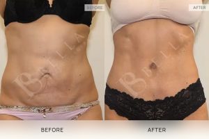 Tummy Tuck Patient 46 - 47