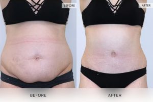 Tummy Tuck Patient 05 - 6