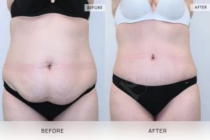 Tummy Tuck Patient 06 - 7