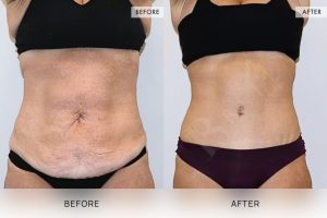 Tummy Tuck Patient 07 - 8