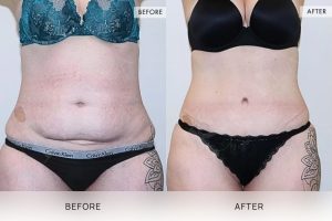Tummy Tuck Patient 08 - 9