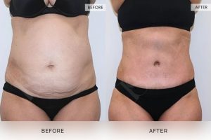 Tummy Tuck Patient 09 - 10