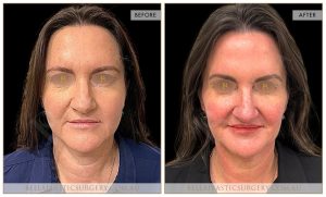 Liquid face lift, before and after 1