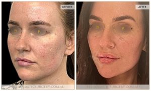 Liquid Face Lift Patient 02 - 1