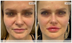 Liquid Face Lift Patient 03 - 2
