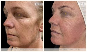 Liquid Face Lift Patient 04 - 3