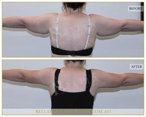 Arm Lift (Brachioplasty) Patient 13 - 14