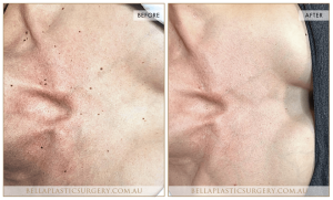 Neck & Décolletage Patient 01 - 2