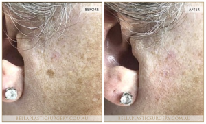 Age Spots Patient 01 - 2