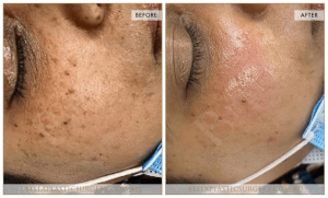 Age Spots Patient 04 - 5
