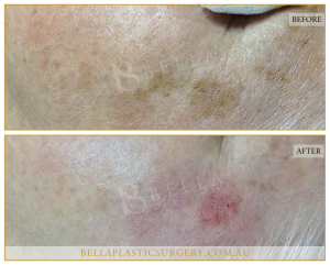 Age Spots Patient 02 - 3