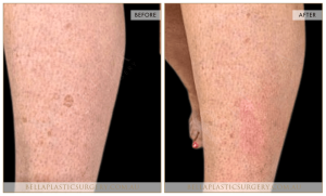 Age Spots Patient 05 - 6